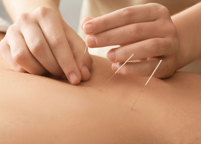 acupuncture-treatment