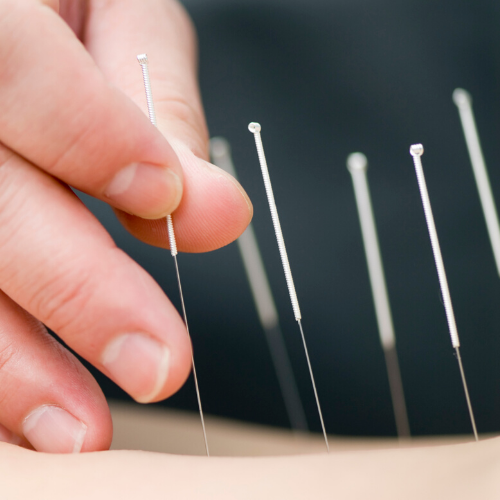 holistic alternative acupuncture therapy